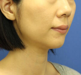 30代女性の小林式ニキビ治療法 After 症例写真