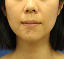 30代女性の小林式ニキビ治療法 Before 症例写真