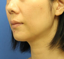 30代女性の小林式ニキビ治療法 Before 症例写真