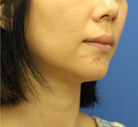 30代女性の小林式ニキビ治療法 Before 症例写真