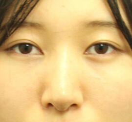 20代女性の3Dリポアイリフト  After 症例写真