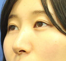 20代女性の3Dリポアイリフト After 症例写真