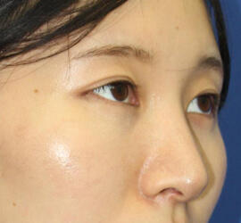 20代女性の3Dリポアイリフト  After 症例写真