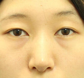 20代女性の3Dリポアイリフト  Before 症例写真