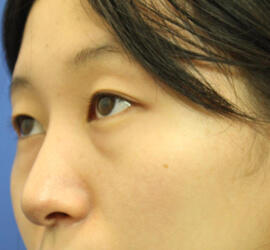 20代女性の3Dリポアイリフト Before 症例写真