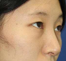 20代女性の3Dリポアイリフト  Before 症例写真