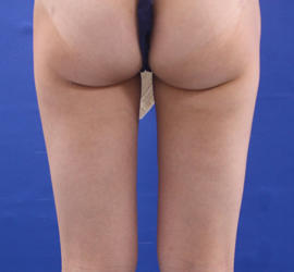 20代女性のピュアグラフト豊胸 After 症例写真