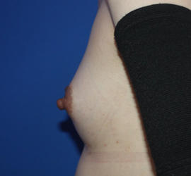 20代女性のピュアグラフト豊胸 After 症例写真