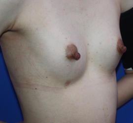 20代女性のピュアグラフト豊胸 After 症例写真