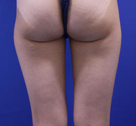 20代女性のピュアグラフト豊胸 Before 症例写真