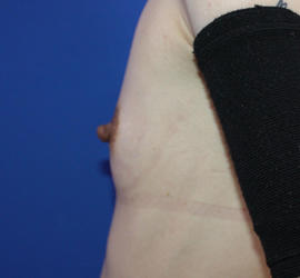 20代女性のピュアグラフト豊胸 Before 症例写真