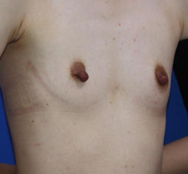 20代女性のピュアグラフト豊胸 Before 症例写真