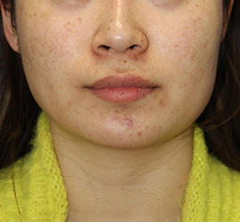 20代女性の顔の脂肪吸引  After 症例写真