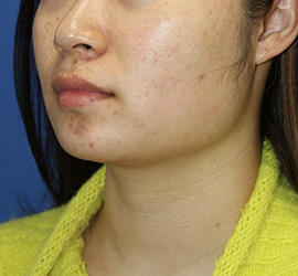 20代女性の顔の脂肪吸引 After 症例写真