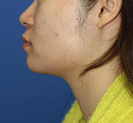 20代女性の顔の脂肪吸引  After 症例写真