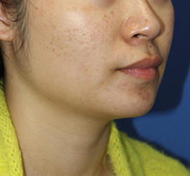 20代女性の顔の脂肪吸引  After 症例写真