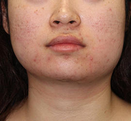 20代女性の顔の脂肪吸引  Before 症例写真