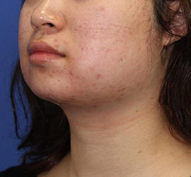 20代女性の顔の脂肪吸引 Before 症例写真