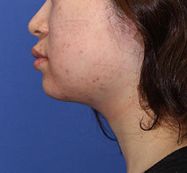 20代女性の顔の脂肪吸引  Before 症例写真