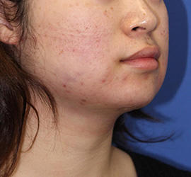 20代女性の顔の脂肪吸引  Before 症例写真