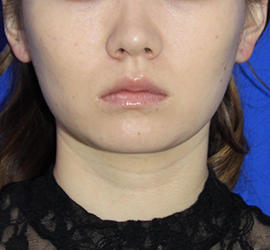 20代女性の顔の脂肪吸引  After 症例写真