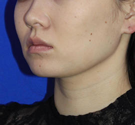 20代女性の顔の脂肪吸引  After 症例写真