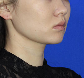 20代女性の顔の脂肪吸引 After 症例写真