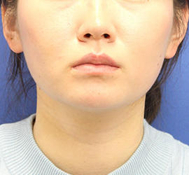 20代女性の顔の脂肪吸引  Before 症例写真