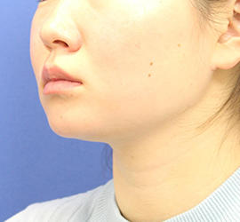 20代女性の顔の脂肪吸引  Before 症例写真