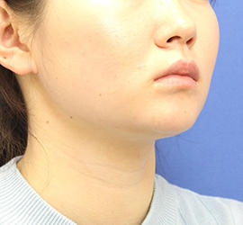20代女性の顔の脂肪吸引 Before 症例写真