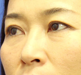 40代女性の肌再生高純度脂肪注入（脂肪移植） After 症例写真