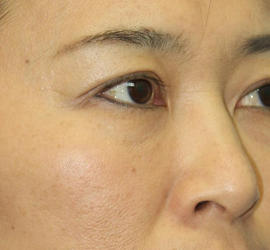 40代女性の肌再生高純度脂肪注入（脂肪移植） After 症例写真