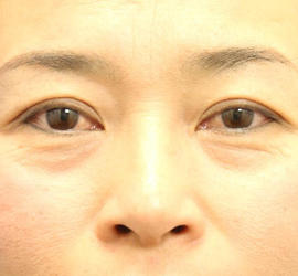 40代女性の肌再生高純度脂肪注入（脂肪移植） Before 症例写真