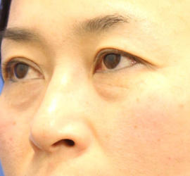 40代女性の肌再生高純度脂肪注入（脂肪移植） Before 症例写真