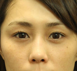 20代女性の目の下の脱脂 After 症例写真