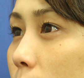 20代女性の目の下の脱脂  After 症例写真