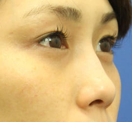 20代女性の目の下の脱脂  After 症例写真