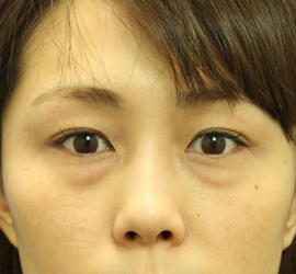 20代女性の目の下の脱脂 Before 症例写真