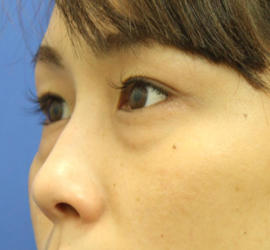 20代女性の目の下の脱脂  Before 症例写真