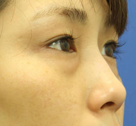 20代女性の目の下の脱脂  Before 症例写真