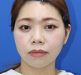 30代女性の3Dリポアイリフト  After 症例写真