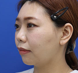 30代女性の3Dリポアイリフト  After 症例写真