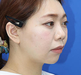 30代女性の3Dリポアイリフト After 症例写真