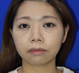 30代女性の3Dリポアイリフト  Before 症例写真