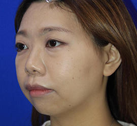 30代女性の3Dリポアイリフト  Before 症例写真