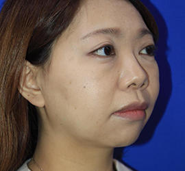 30代女性の目の下のクマ治療 Before 症例写真