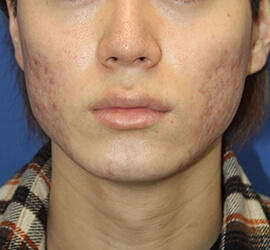 20代男性の小林式ニキビ治療法 After 症例写真