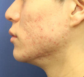 20代男性の小林式ニキビ治療法 After 症例写真