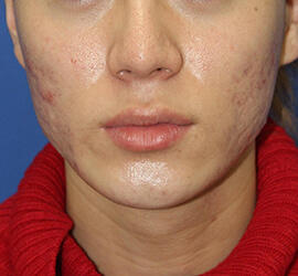 20代男性の小林式ニキビ治療法 Before 症例写真