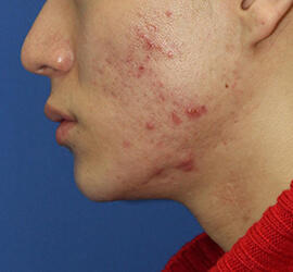 20代男性の小林式ニキビ治療法 Before 症例写真